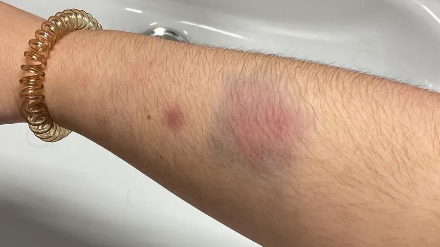 Bruised forearm with a coil hair-tie bracelet, over the sink
