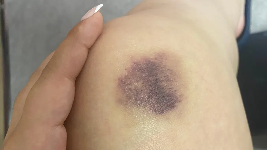 Big purple bruise on a thigh, a hand pointing at it