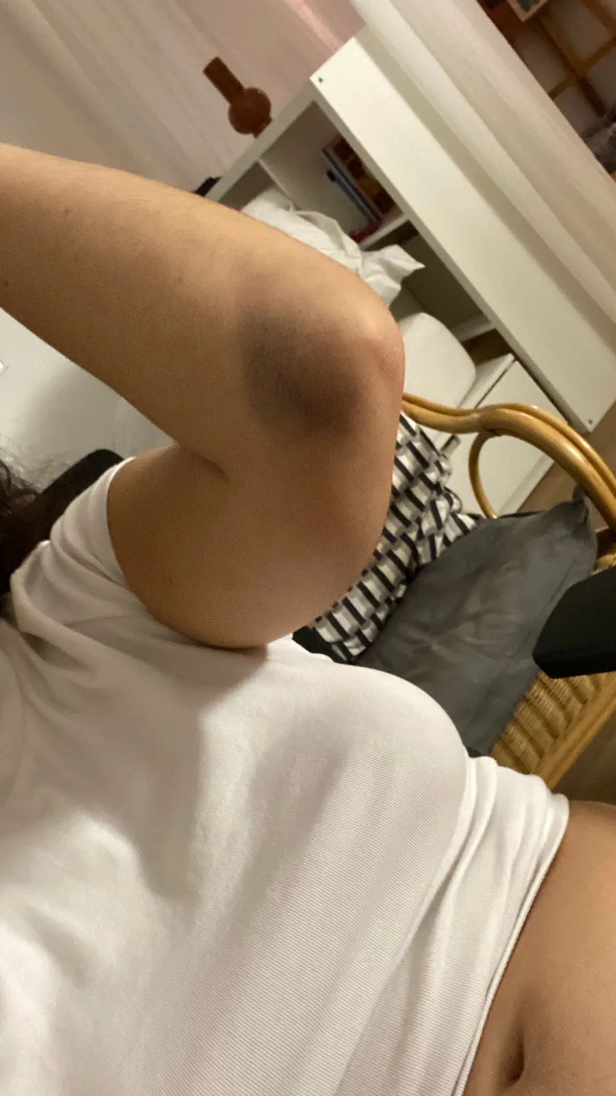 Bruised elbow raised against a white sleeve