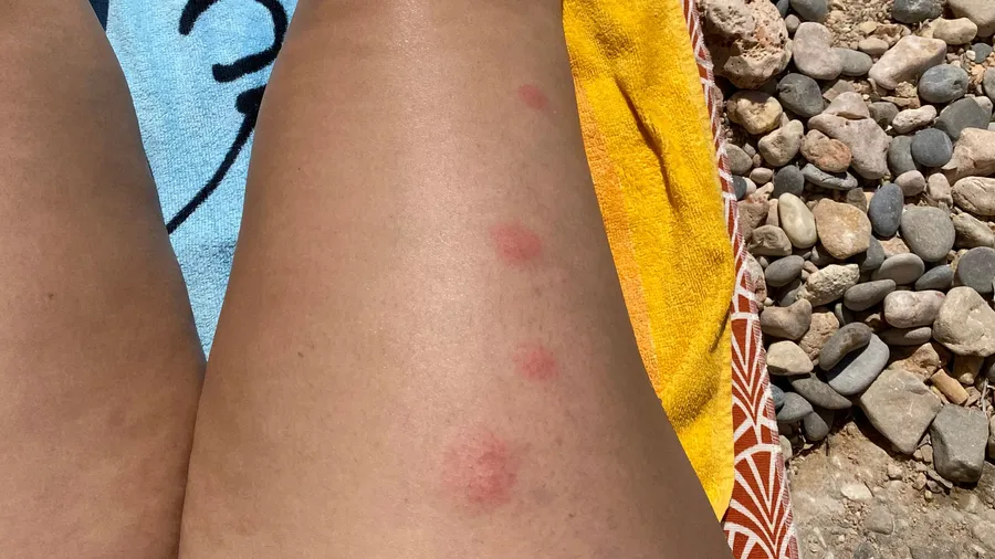 Mosquito-bitten legs on a towel by the pebbles