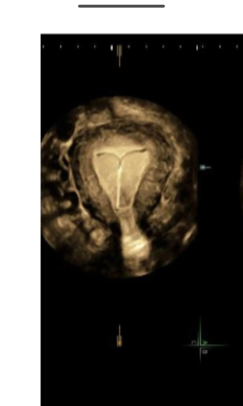Sepia 3D ultrasound screenshot of an IUD